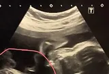 Đi khám thai, người phụ nữ 32 tuổi sốc nặng khi thấy kết quả siêu âm