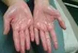 Khuyên thật: Thấy 5 thứ trên bàn tay phải đi khám thận ngay!