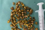Người phụ nữ 39 tuổi đau bụng không chịu nổi, bác sĩ gắp ra thứ "đáng sợ" bên trong