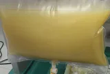 Máu trắng đục như sữa, nam sinh viên gặp biến chứng vì kiểu ăn uống quen thuộc