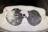 Bé gái 6 tuổi ho suốt ngày, bố mẹ sốc khi bác sĩ lấy thứ "đáng sợ" lấp đầy hai lá phổi