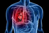 Không hút thuốc vẫn mắc ung thư phổi: Bác sĩ Bạch Mai chỉ ra những nguyên nhân ít người biết
