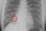 Bé 13 tuổi ho mãi không thôi, bác sĩ phát hiện thứ "đáng sợ" bên trong