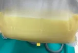 Người phụ nữ 32 tuổi máu "trắng đục như sữa", bác sĩ "chỉ mặt điểm tên" thói quen ít ai ngờ