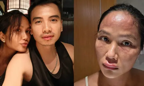 Hoa hậu H'Hen Niê sau khi bị biến dạng mặt