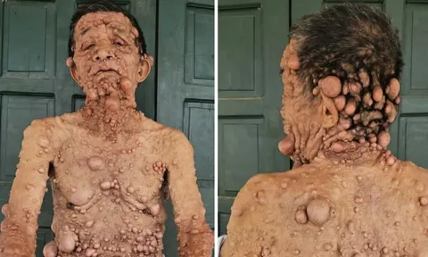 Cụ ông nổi u cục khắp người bị cắt chế độ khuyết tật: Được nhận lại trợ cấp sau phản ánh của Người Đưa Tin