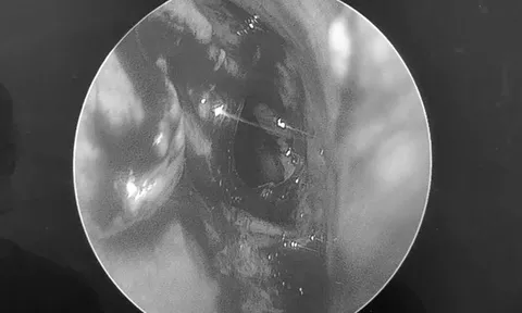Đi khám, người đàn ông sốc nặng khi bác sĩ thấy thứ "đáng sợ" trong mũi mình