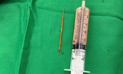 Người đàn ông bụng "cứng như đá" 2 tuần, bác sĩ phát hiện nguyên nhân bất ngờ