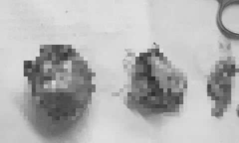 Người phụ nữ 66 tuổi đau bụng kéo dài, bác sĩ gắp ra thứ "đáng sợ"