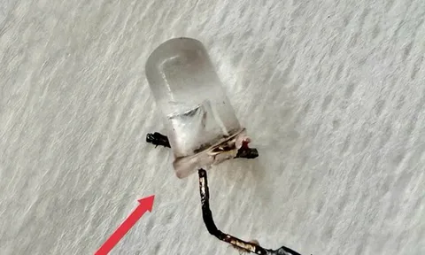 Bé 9 tháng tuổi ho nhiều ngày, bố mẹ "sốc" khi bác sĩ gắp ra đèn LED nằm trong phế quản