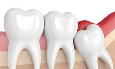 Nhổ răng khôn có được BHYT chi trả?