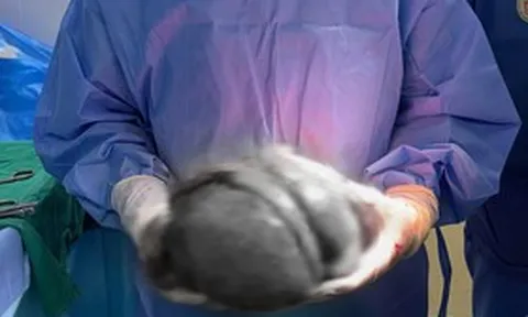 Đau bụng âm ỉ suốt nhiều tháng, người đàn ông sốc nặng khi phát hiện thứ "đáng sợ" trong bụng