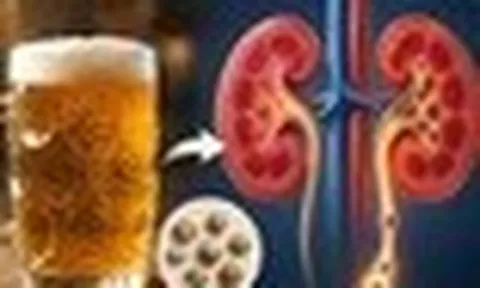 Uống bia giúp đào thải sỏi thận?