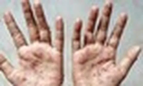 TPHCM có ca đậu mùa khỉ: Bác sĩ lưu ý dấu hiệu cần khám sớm