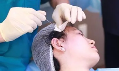 Trào lưu tự căng da mặt tại nhà gây sốc: Nhiều cô gái đối mặt nguy cơ hủy hoại gương mặt