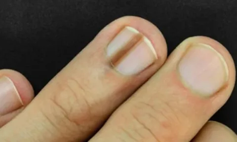 6 bất thường trên móng tay có thể đang “tố cáo” bệnh trong cơ thể bạn