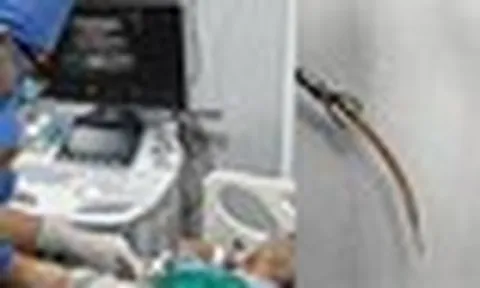 Đau bụng suốt 10 ngày, bất ngờ phát hiện tăm tre đâm thủng đại tràng