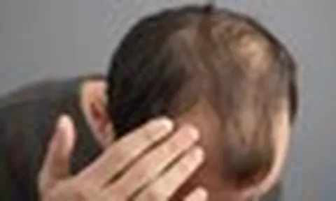 Thường xuyên ăn 5 món này, đừng trách vì sao tóc rụng lả tả