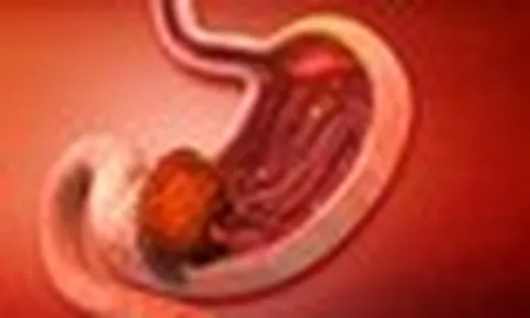 Ung thư dạ dày thường "để ý" tới những người có 5 thói quen này: Có 1 cũng phải bỏ ngay
