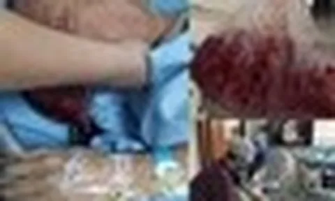 Người đàn ông nôn ra hơn 2 lít máu trong 5 phút, bác sĩ cảnh báo: 4 thói quen ăn uống "phá nát" dạ dày