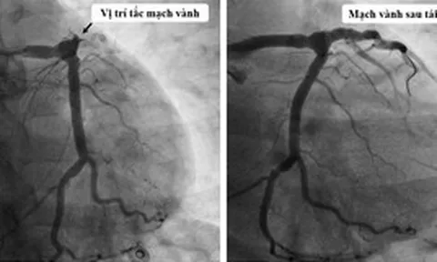 Nam thanh niên 25 tuổi suýt chết vì nhồi máu cơ tim: 10 năm trước đã làm 1 việc không ai ngờ, bác sĩ bệnh viện E lập tức cảnh báo