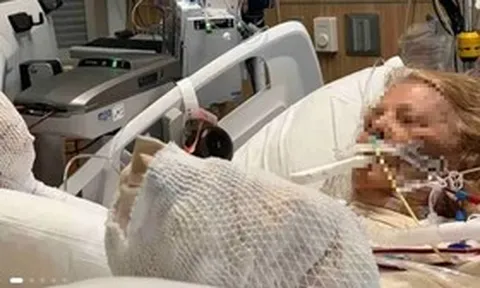 Người phụ nữ 82 tuổi suýt chết vì ngủ ngoài trời nắng theo cách "vạn người mê"
