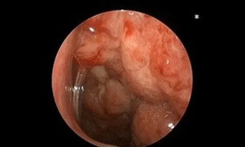 Tưởng chỉ viêm mũi họng thông thường, bệnh nhi 14 tuổi phát hiện ung thư di căn