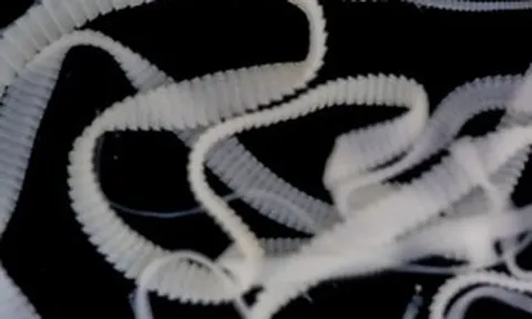 Đi du lịch về, cô gái phát hiện 38 nang sán "đáng sợ" trong não