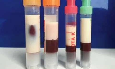 Người phụ nữ 31 tuổi "máu đặc vàng như kem" vì ăn món quen thuộc suốt 4 tháng