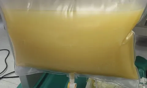 Máu trắng đục như sữa, nam sinh viên gặp biến chứng vì kiểu ăn uống quen thuộc