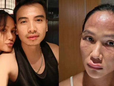 Hoa hậu H'Hen Niê sau khi bị biến dạng mặt