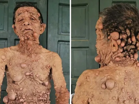 Cụ ông nổi u cục khắp người bị cắt chế độ khuyết tật: Được nhận lại trợ cấp sau phản ánh của Người Đưa Tin