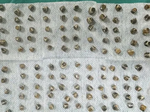 Đau bụng đi khám, người phụ nữ 40 tuổi sốc khi bác sĩ gắp ra thứ "đáng sợ" bên trong