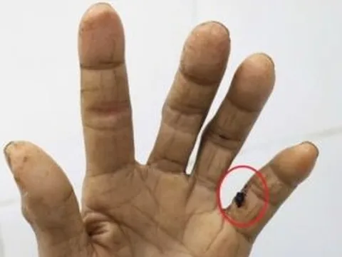 Người phụ nữ 60 tuổi "cứng hàm" suýt mất mạng vì bị gà đá