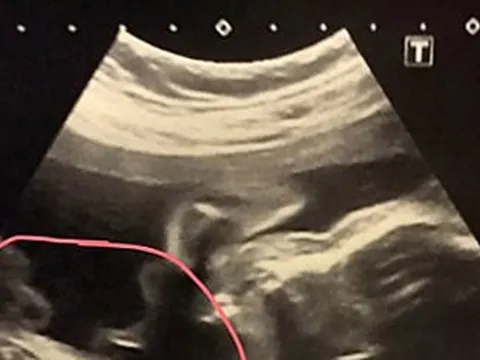 Đi khám thai, người phụ nữ 32 tuổi sốc nặng khi thấy kết quả siêu âm