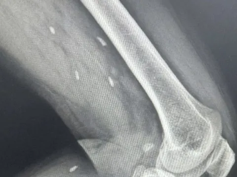 Thói quen nhiều người Việt mê mẩn khiến sán “làm tổ” dưới da mà không hay biết