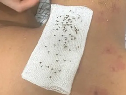 Hai bố ngất xỉu khi đi tìm tổ chim, đến viện bác sĩ chỉ ra nguyên nhân "đáng sợ"