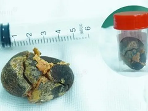 Đi khám sức khỏe định kỳ, người phụ nữ "sốc" khi phát hiện điều bất ngờ