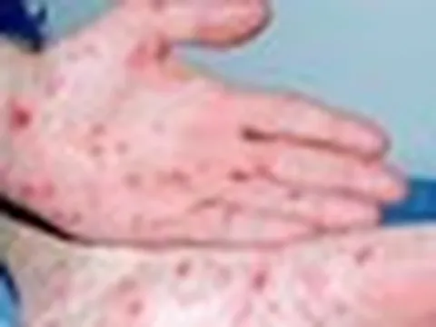 TPHCM: Số người mắc bệnh giang mai tăng đột biến