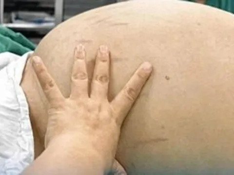 Thiếu nữ 19 tuổi bụng to như bầu, bác sĩ phát hiện bí mật "đáng sợ" bên trong