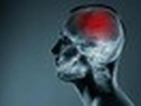 Nghiên cứu mới về đột quỵ lật đổ quan niệm y học hàng thập kỷ