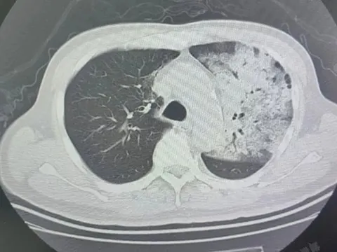 Người đàn ông 70 tuổi, tưởng cảm cúm hóa ra phổi “trắng xóa”: Biết "thủ phạm" nhiều người hoang mang