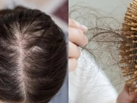 Đừng chỉ ăn trứng luộc để ngừa tóc rụng! "Nữ thần không tuổi" Thái Y Lâm luôn làm việc này trước 21h30 cho da đẹp tóc khỏe, bác sĩ cũng phải khen