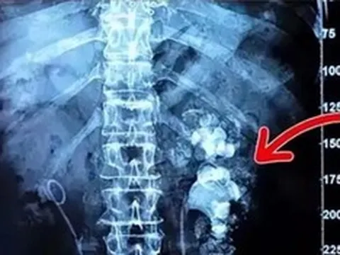 Cô gái trẻ nhập viện, bác sĩ phát hiện hai bên thận chi chít sỏi vì món đồ uống yêu thích