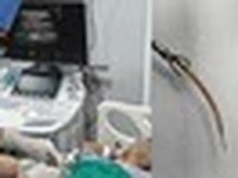 Đau bụng suốt 10 ngày, bất ngờ phát hiện tăm tre đâm thủng đại tràng