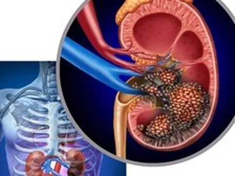 Người đàn ông bất ngờ phát hiện ung thư thận khi đi khám sức khỏe định kỳ: Tôi mới 32 tuổi, sao có thể...