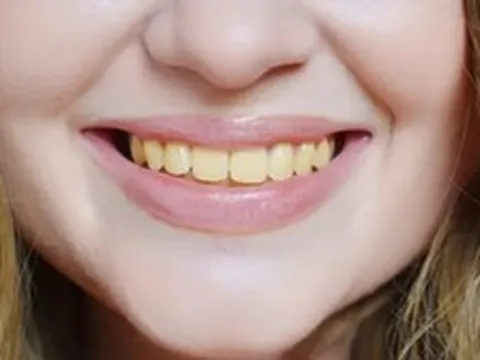Chuyên gia chỉ ra 4 thực phẩm làm răng ố vàng, đánh mãi vẫn không trắng