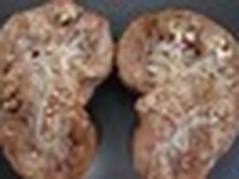 Người phụ nữ 58 tuổi thận bám đầy mủ, suýt mất thận: BS cảnh báo tuyệt đối không trì hoãn đi bệnh viện khi cơ thể phát tín hiệu