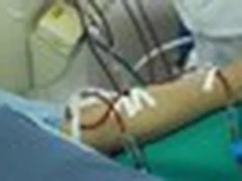 Có dấu hiệu này cần nghĩ tới suy thận - bác sĩ cảnh báo