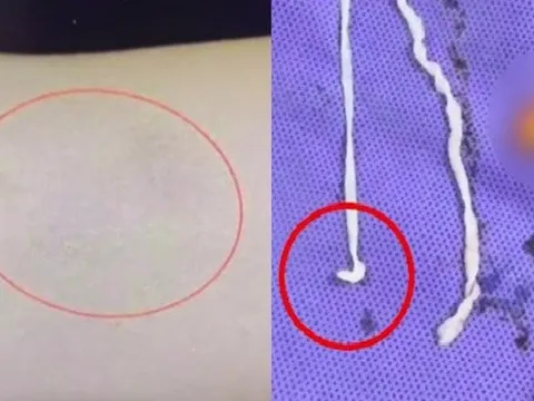 Người phụ nữ đau tay đi khám, bác sĩ kinh ngạc khi thấy thứ bên trong